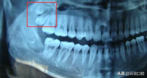 兩顆智齒長在了一個地方？這樣的智齒要怎麼辦？ 每日頭條