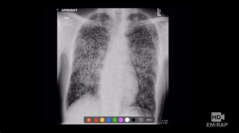 In this paper, detection of pneumonia infection by unsupervised fuzzy. HD - Chest X-Ray in Pneumonia | EM:RAP