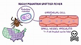 Rocky Mountain spotted fever (RMSF): Nursing - Osmosis Video Library