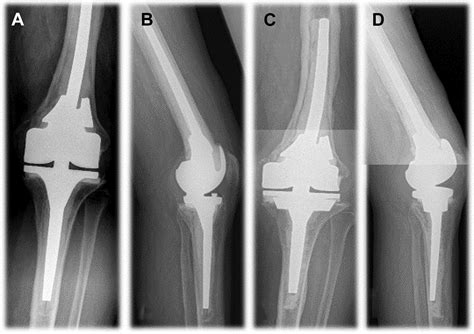 Clinical Survivorship Of Aseptic Revision Total Knee Arthroplasty Using