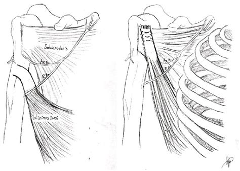 Anterior Latissimus Dorsi Tendon Transfer Before And After Diagrams Of