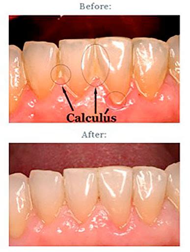 Dental Plaque And Calculus Blog