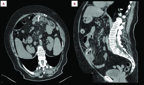 Unenhanced Ct Scan Performed On Axial Oblique A And Sagittal B