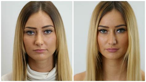 Lip Filler Photos Before And After My Xxx Hot Girl