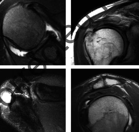 MRI Of Cuff Tear Combined With Labral Tear And Os Acromiale Download