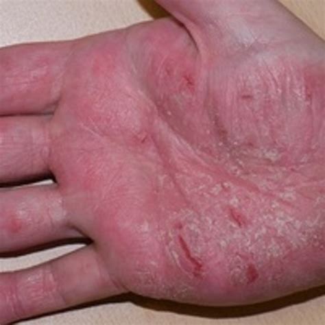 Lista 98 Foto Fotos De Dermatitis En Las Manos El último