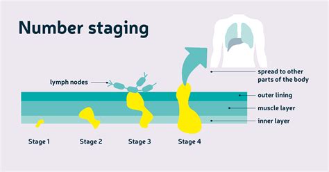 Staging And Grading Diagnosis About Bowel Cancer Bowel Cancer Uk