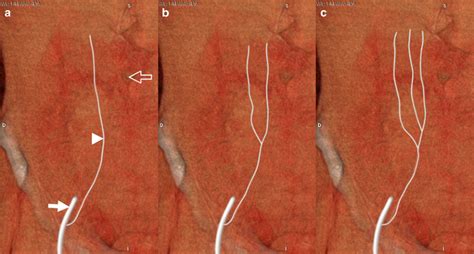 Preoperative Imaging In The Planning Of Deep Inferior Epigastric Artery