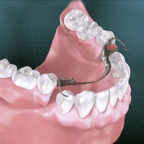 Partial Dentures Riset