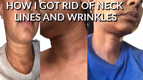 How To Get Rid Of Neck Wrinkles And Dark Lines Youtube