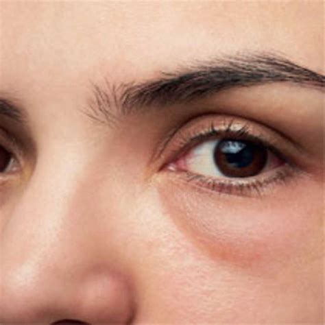 Why Do I Get Swollen Eyes In The Morning Causes And Treatments