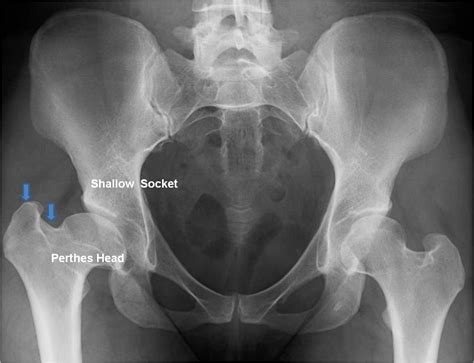 Pao And Surgical Dislocation For A Perthes Deformity In A 29 Year Old