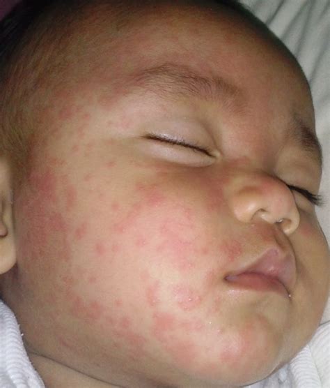 List 104 Wallpaper Pictures Of Roseola On Babies Stunning 102023