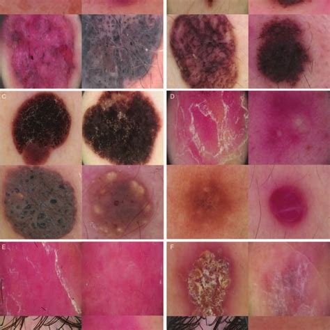 Example Dermoscopic Images Basal Cell Carcinoma A Melanocytic Nevus