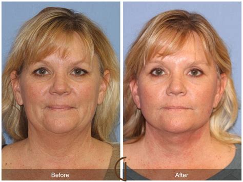 Neck Lift Before And After Photos Patient 77 Dr Kevin Sadati