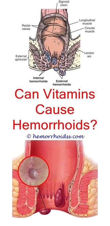How To Soothe Hemorrhoid Itching How To Know When A Hemorrhoid Is