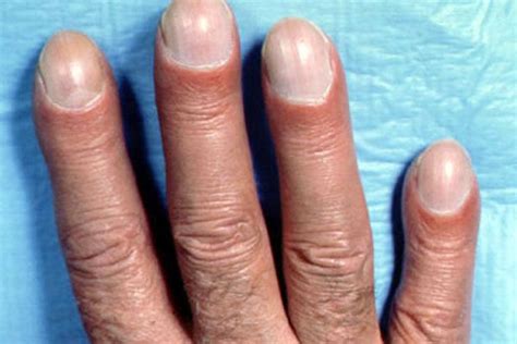 Everything You Need To Know About Clubbed Fingers