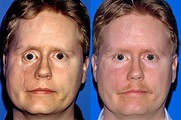 Post-Traumatic Facial Deformities