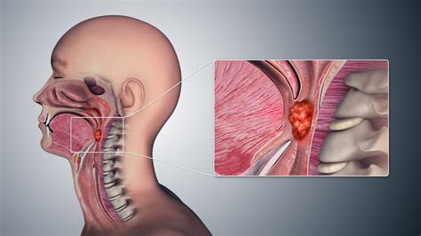 Throat Cancer Early Signs Symptoms Causes And Prognosis Remedies Lore