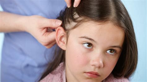 20 Ways To Get Rid Of Head Lice Health