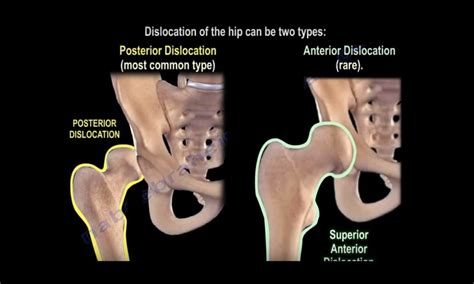 Hip Dislocations And Its Implications OrthopaedicPrinciples Com