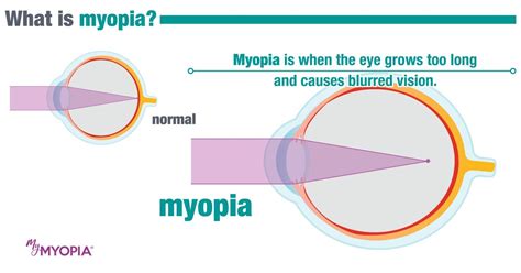 Myopia Control Global Eyecare Optometry