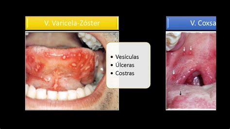 Lesiones De La Mucosa Oral Youtube