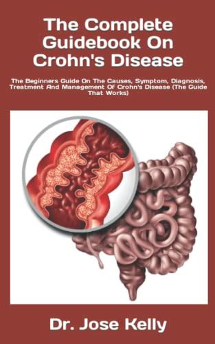 The Complete Guidebook On Crohn S Disease The Beginners Guide On The Causes Symptom Diagnosis