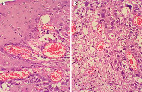 Acantholytic Squamous Cell Carcinoma Marked Acantholysis Of The