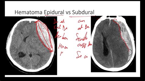 Diferencia En 2 Minutos De Hematoma Epidural Vs Subdural Tomografía