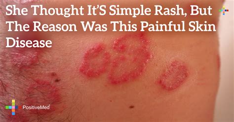 She Thought It S Simple Rash But The Reason Was This Painful Skin Disease Positivemed