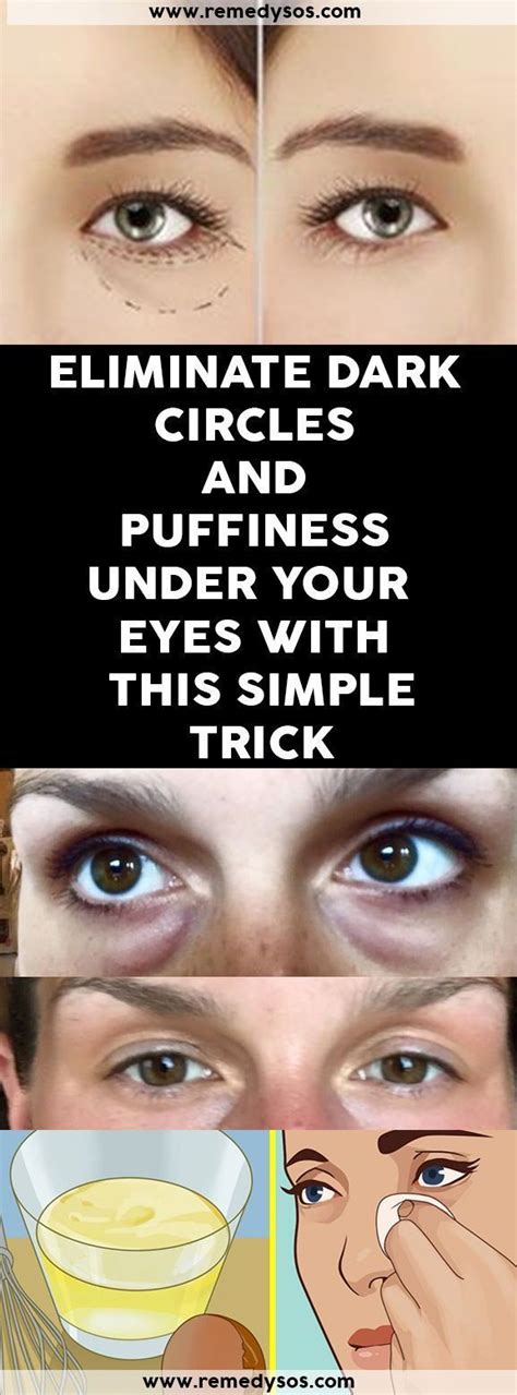 Eliminate Dark Circles And Puffiness Under Your Eyes With This Simple