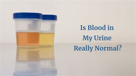 So Is Blood In My Urine Really Normal Bladder Concerns ⋆