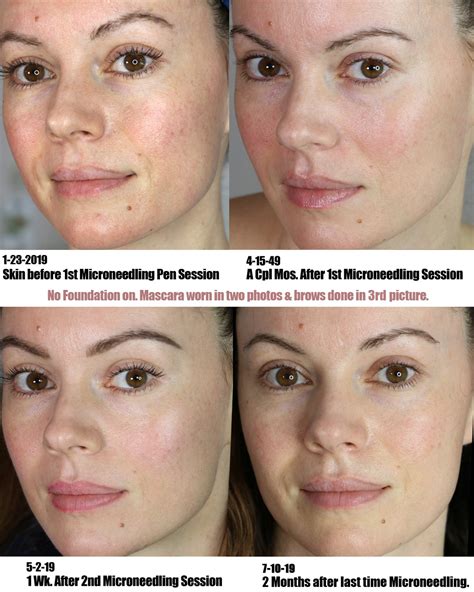 Skincare Microneedling Update Life And Diy