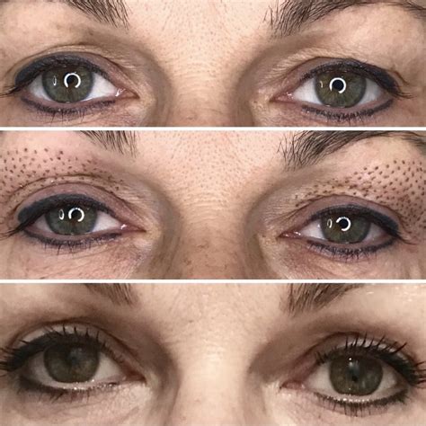 Plasma Revive Eye Lift And Skin Tightening Without Surgery