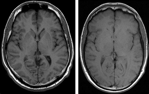 Advantages And Pitfalls In 3t Mr Brain Imaging A Pictorial Review