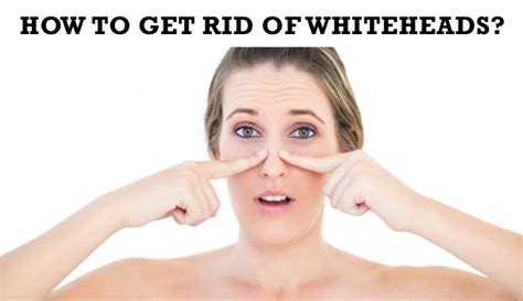 How To Get Rid Of Whiteheads In 5 Minutes Candy Crow