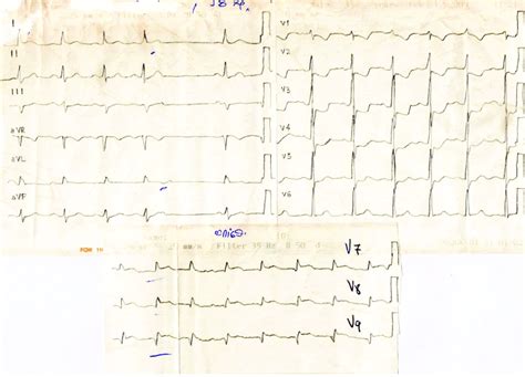 15 Lead Ecg Of A Patient From Group B The Ecg
