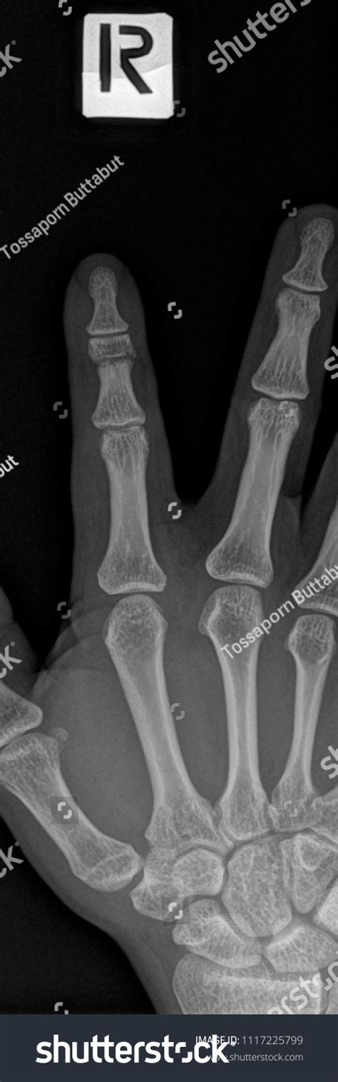 Xray Right Index Finger Fracture Malunion Stock Photo 1117225799