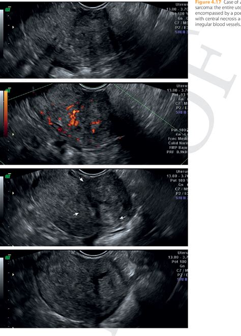 Figure 412 From Sonographic Assessment Of Uterine Fibroids And