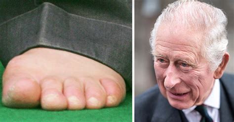 King Charles Sausage Toes Could Suggest Systemic Condition Expert