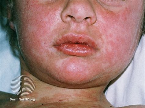 Measles Kidshealth Nz