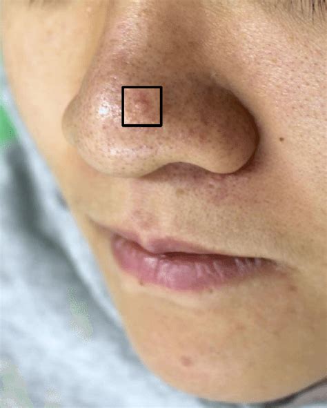 Papules On Nose