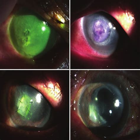 A Opaque And Bullous Cornea With Neovascularization Is Seen By Slit