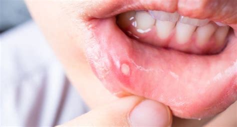 Canker Sore Doctor