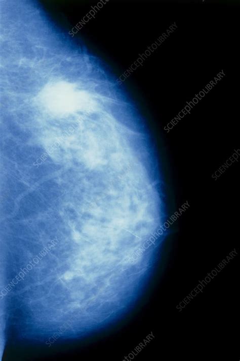Mammogram Of Breast Showing Cancerous Tumour Stock Image M1220020
