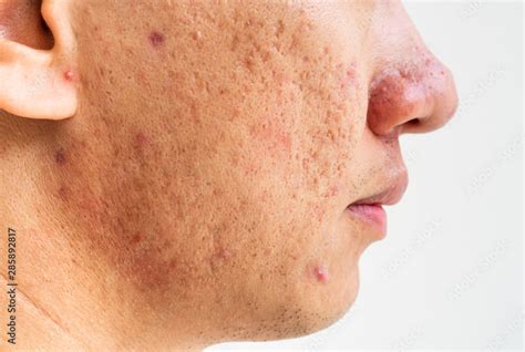 Close Up Of Problematic Skin With Deep Acne Scars On Cheek Men