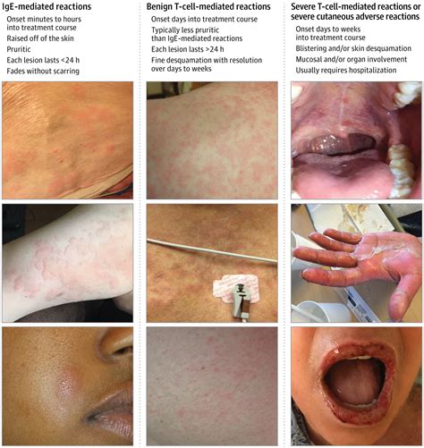 Evaluation And Management Of Penicillin Allergy A Review Allergy