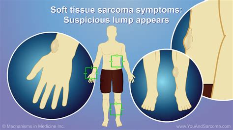 Diagnosing And Treating Soft Tissue Sarcoma Sarcoma Tissue Soft