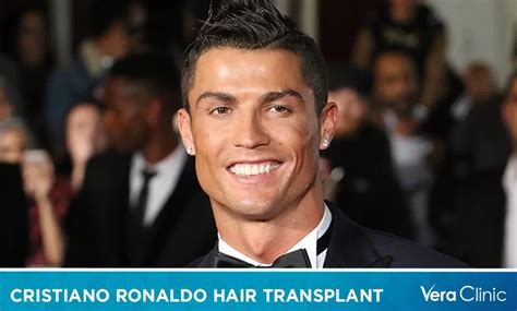 Cristiano Ronaldo Hair Transplant The Iconic Transformation